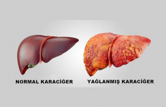 Karaciğer Yağlanması Enginar Sirkesi-Deve Dikeni